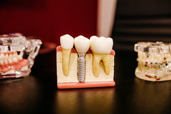 Implante dentário — modelo com coroa sobre raiz em titânio